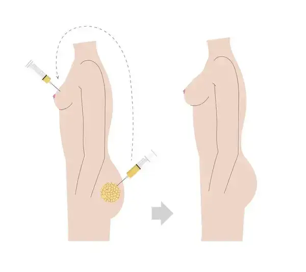 Lipofilling biustu – czy warto? Opinie i doświadczenia kobiet.