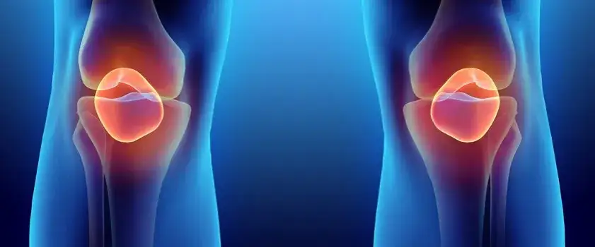 Chondromalacja rzepki objawy - jak rozpoznać ból kolana i unikać komplikacji