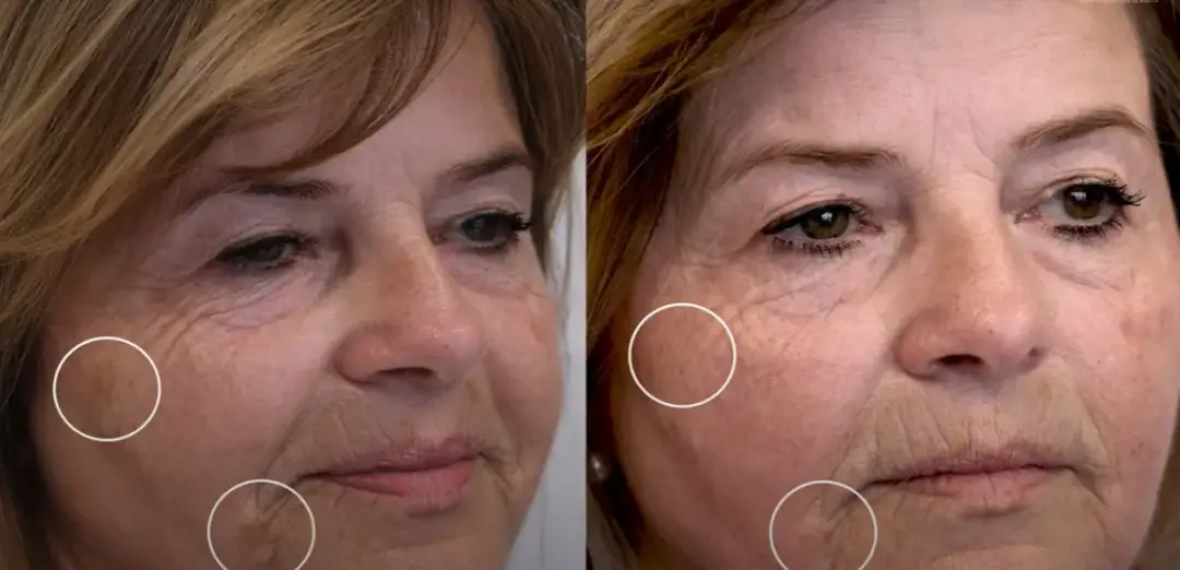 Laser frakcyjny po jakim czasie efekty – poznaj prawdę o rezultatach