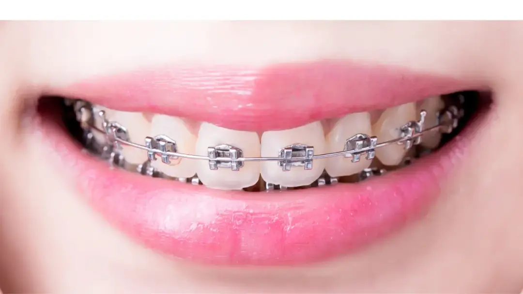 Kiedy założyć dziecku stały aparat na zęby, aby uniknąć problemów?