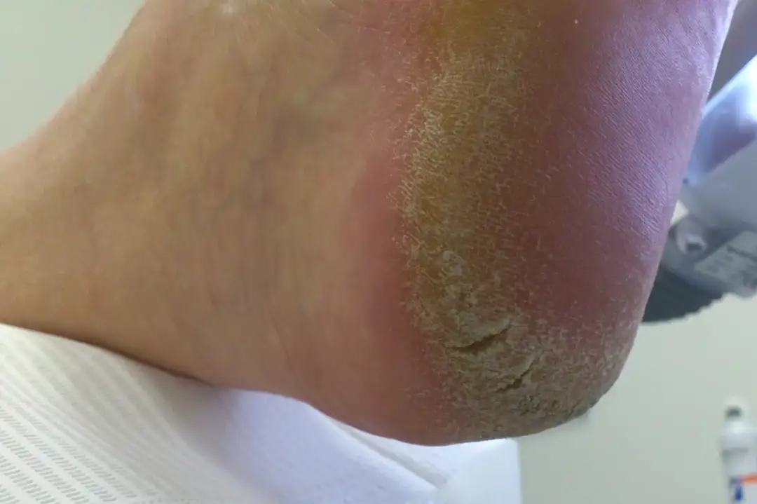 Pękające pięty: Odkryj przyczyny i skuteczne metody leczenia