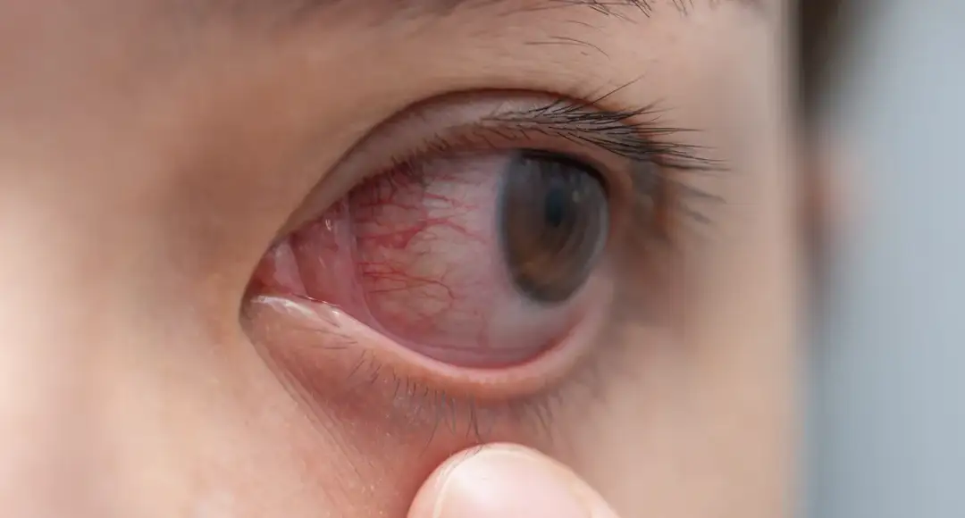 Pasożyty w oczach: Niewidoczne, ale niebezpieczne. Jak wykryć?