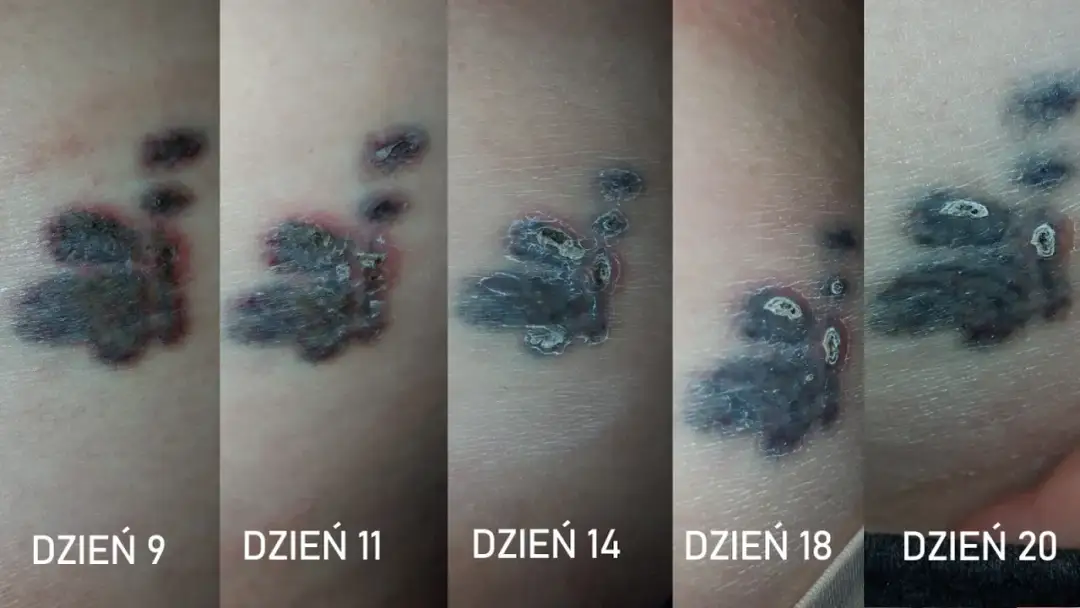 Czy antybiotyk po tatuażu szkodzi? Wszystko o bezpieczeństwie i gojeniu