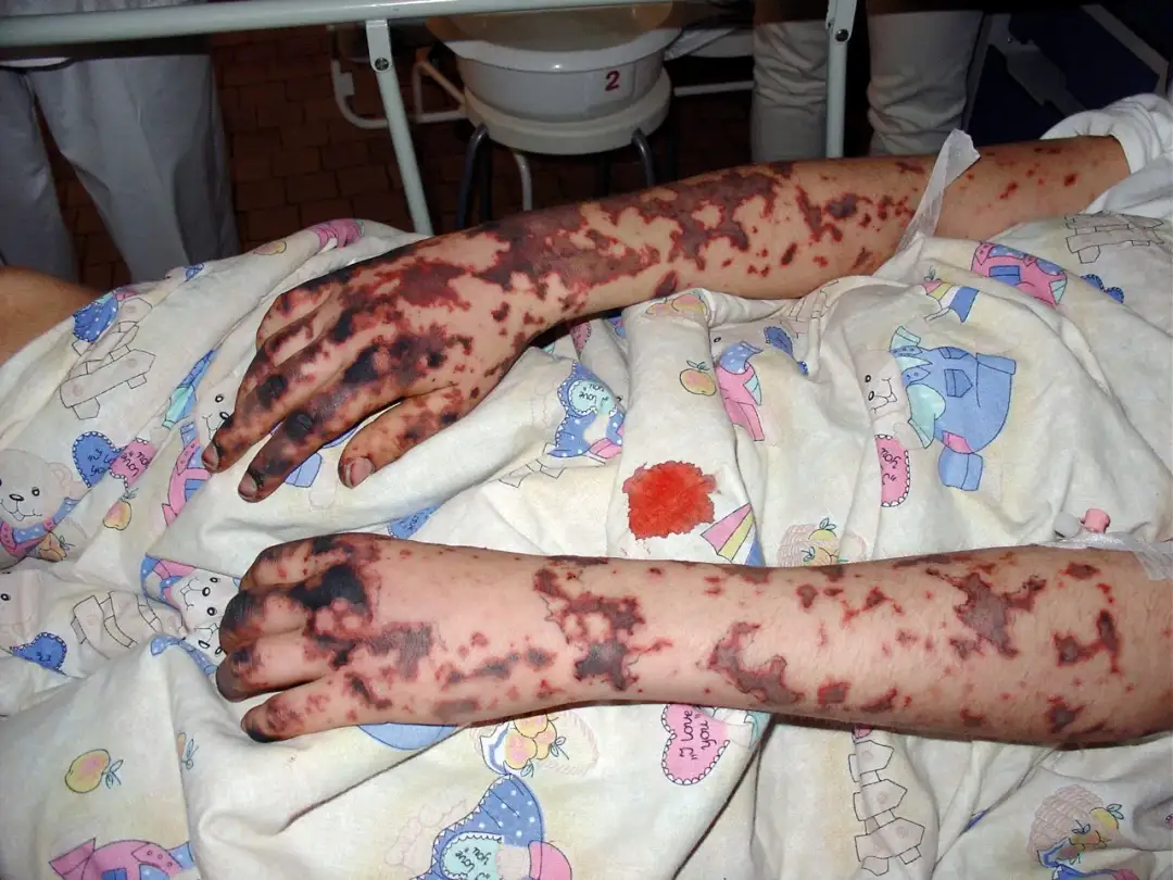 Czy sepsa jest zakaźna? Poznaj fakty i rozwiej wątpliwości o zakażeniu