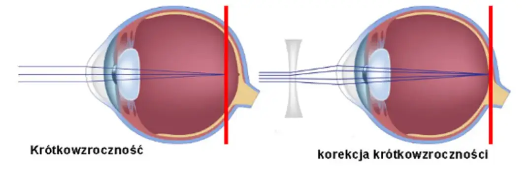 Jakie wady wzroku mogą się cofnąć? Fakty i skuteczne metody