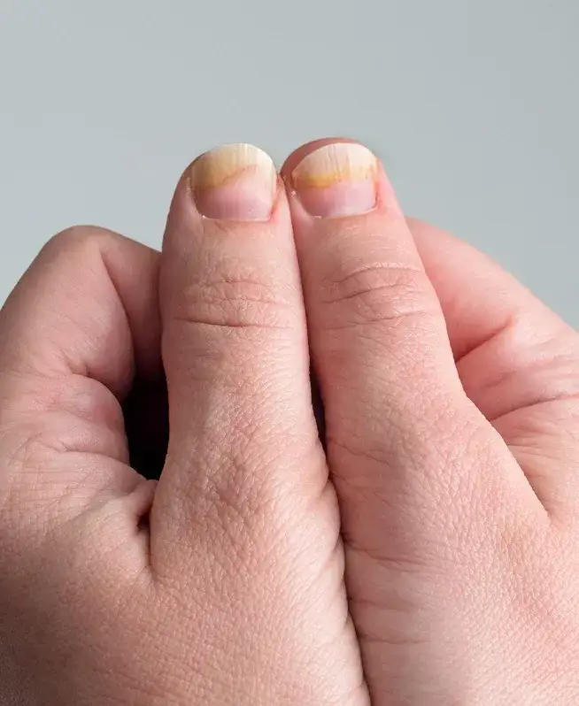 Grzybica paznokci po hybrydzie: 5 skutecznych metod leczenia