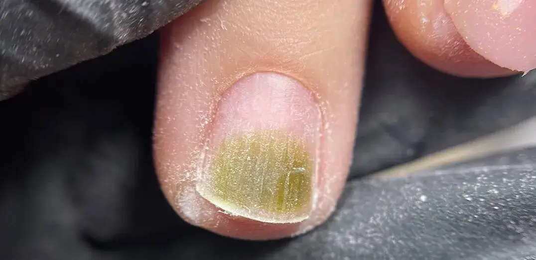 Zielona bakteria na paznokciu - nie maluj! Poznaj przyczyny