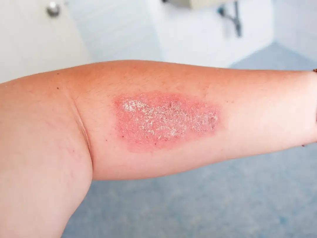 Czy gronkowiec jest zakaźny? Poznaj objawy i drogi zakażenia - poradnik