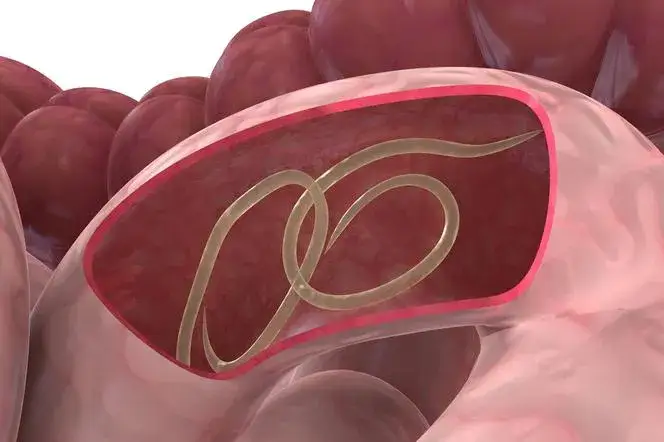 Niebezpieczne objawy glisty ludzkiej u dzieci. Jak rozpoznać i leczyć?