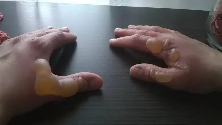 Oparzenie gazem LPG co robić: skuteczne metody pomocy i bezpieczeństwa