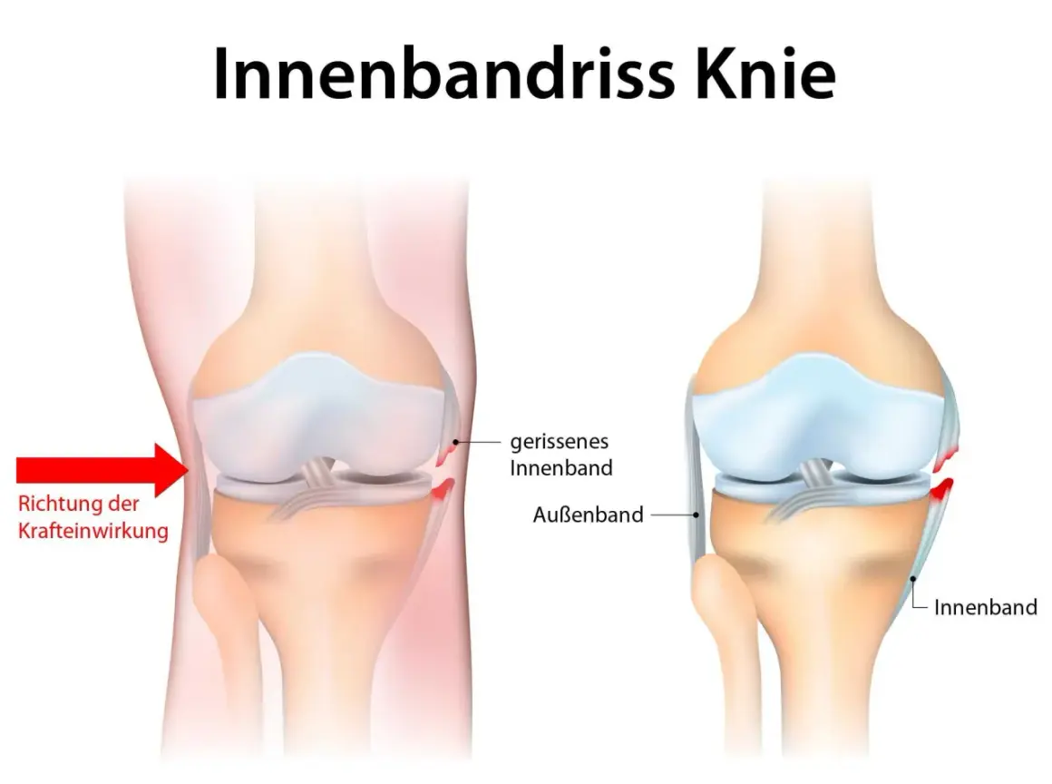 Illustration zeigt einen **Innenbandriss Knie**. Links die Kraftrichtung, rechts das gerissene Innenband im Vergleich zum gesunden.