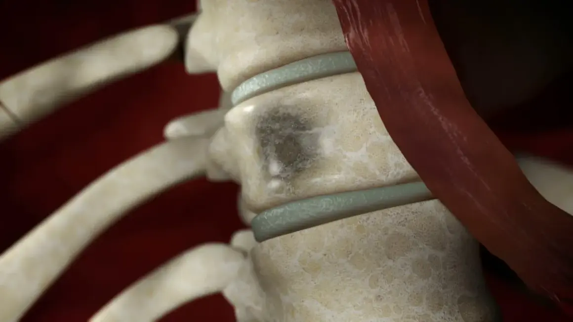 Detailaufnahme der Wirbelsäule mit einem dunklen Fleck auf einem Wirbelkörper, der auf multiples Myelom hindeutet. Woran stirbt man bei dieser Krankheit, ist eine wichtige Frage.