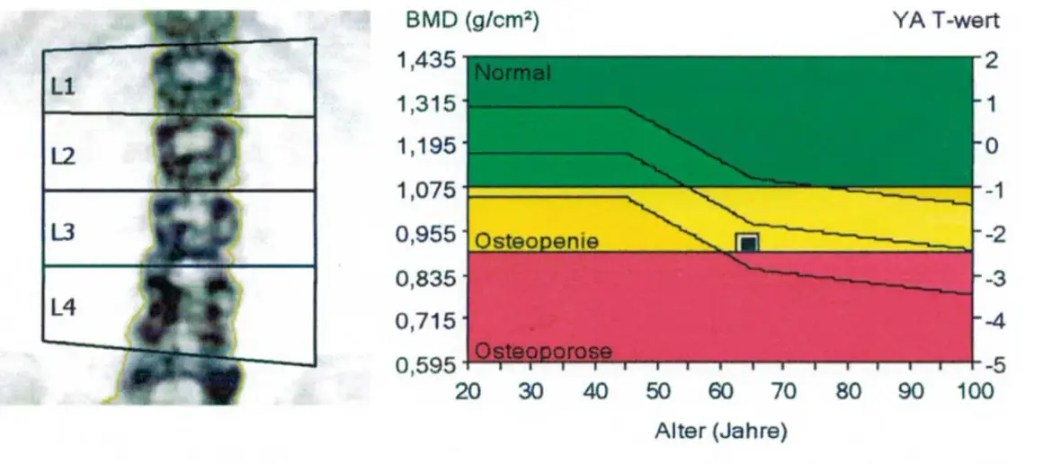 Osteoporose werte tabelle: Röntgenaufnahme der Lendenwirbel und eine Grafik, die den T-Wert im Verhältnis zum Alter zeigt. Grün: Normal, Gelb: Osteopenie, Rot: Osteoporose.