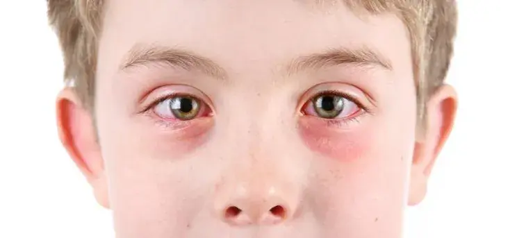 Alergia oczu: objawy, rozpoznanie i skuteczne sposoby na ulgę