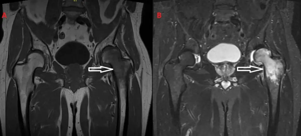Risonanza magnetica pelvica: edema osseo nel femore sinistro, che potrebbe indicare un tumore.