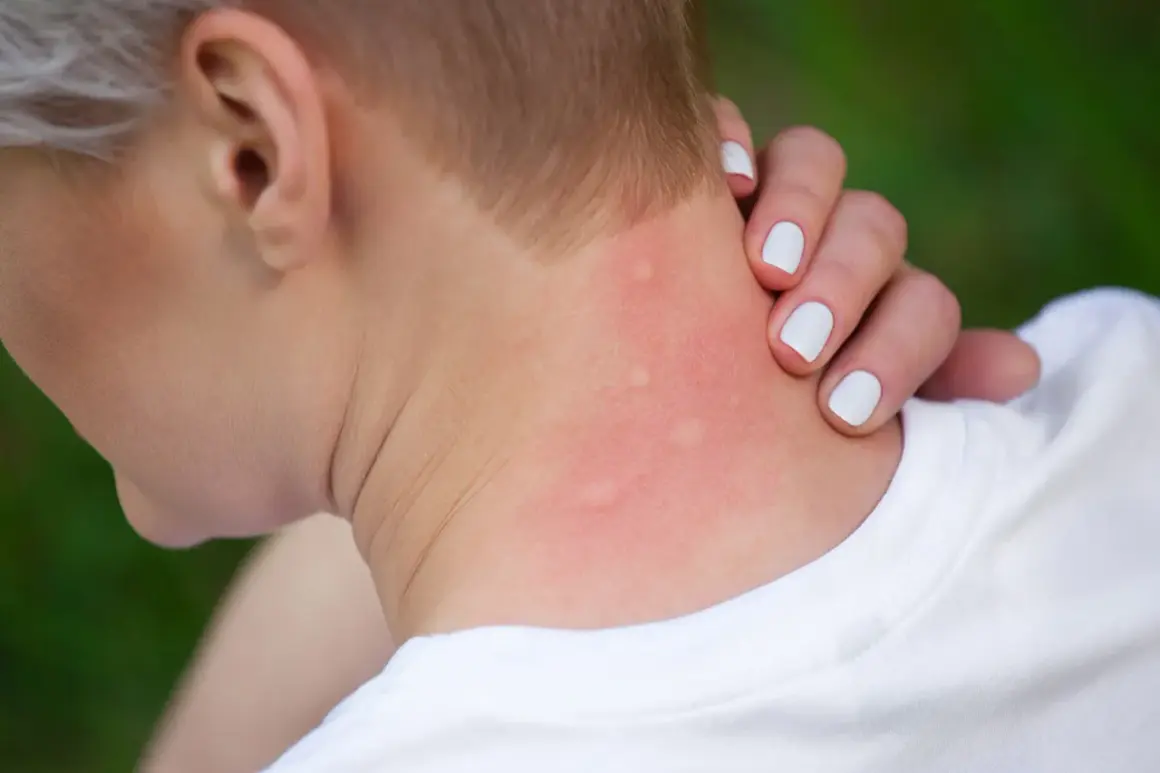 Rote, geschwollene Stellen am Hals, deutliche Anzeichen einer starken Schwellung nach Insektenstich.