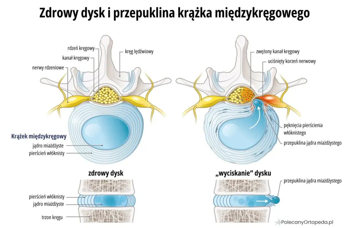Porównanie zdrowego krążka międzykręgowego z jego przepukliną, która uciska nerwy. Widoczna protruzja krążka.