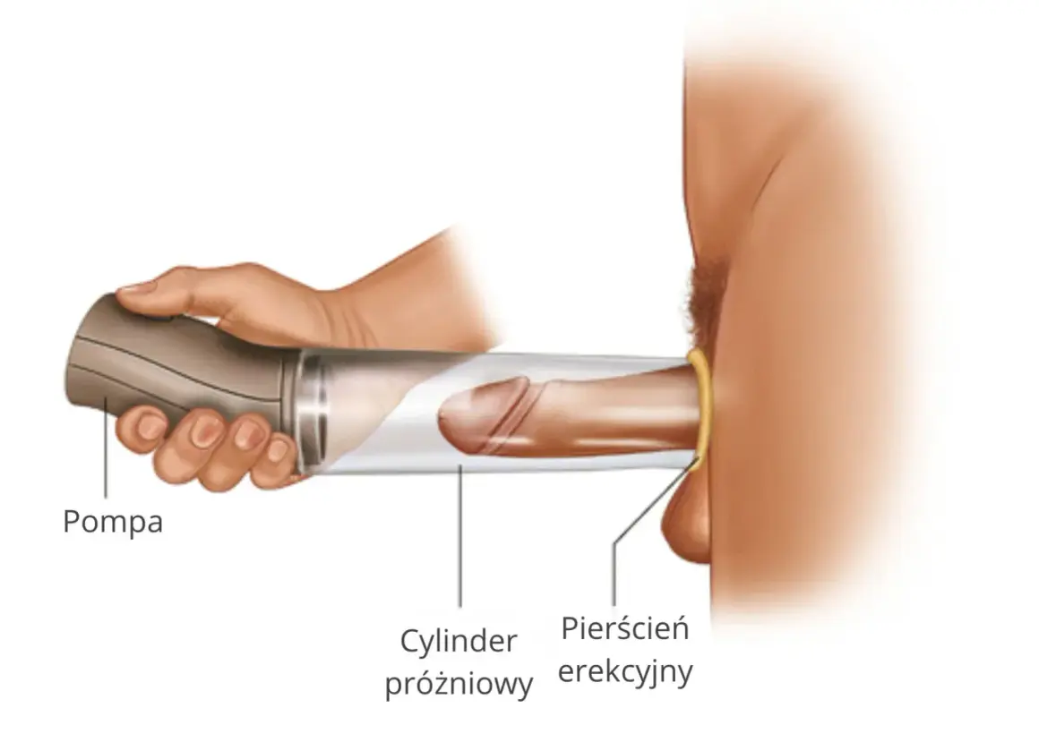 Pompka erekcyjna apteka: ilustracja pokazuje użycie cylindra próżniowego i pierścienia erekcyjnego do wspomagania erekcji.