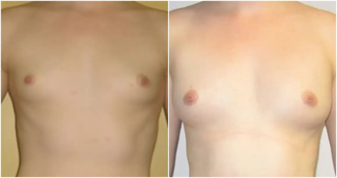 Przed i po lipotransferze biustu: widoczne powiększenie i wymodelowanie piersi. Efekty lipotransferu biustu są widoczne.