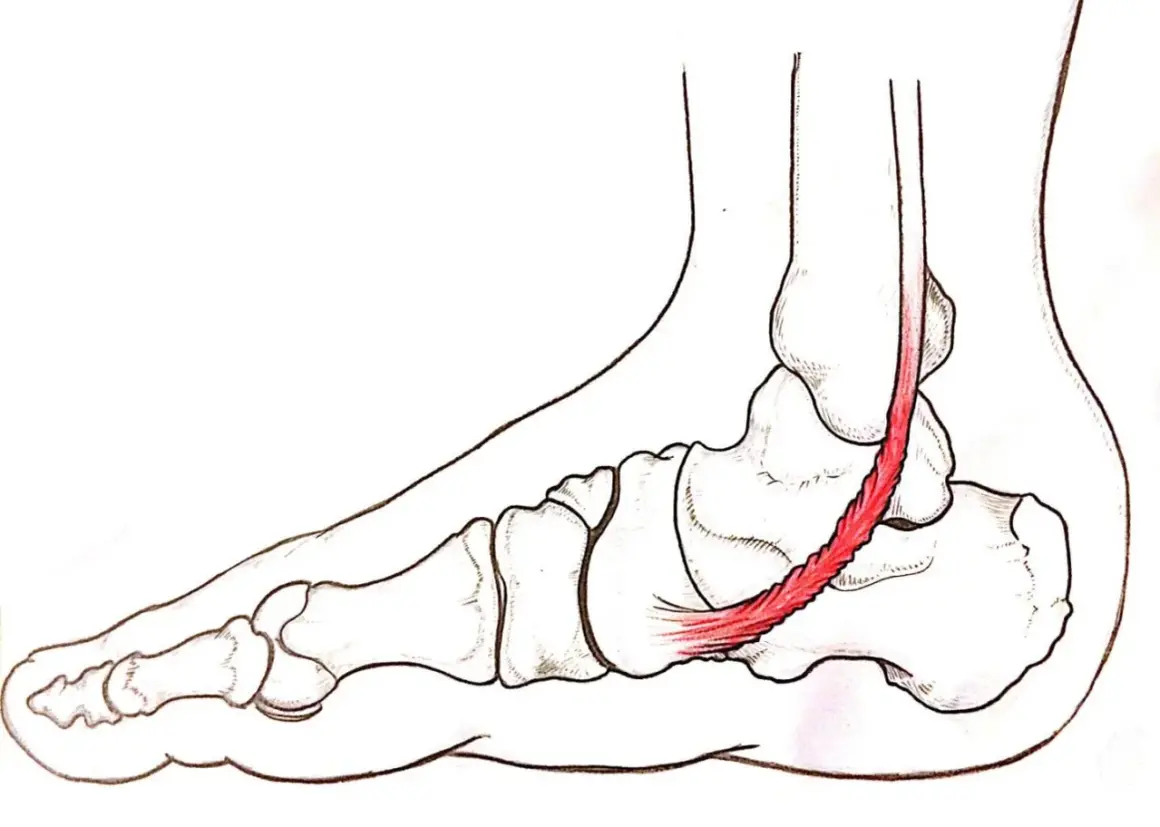 Illustrazione anatomica del piede con tendine d'Achille infiammato, evidenziando la **tendinite caviglia**.