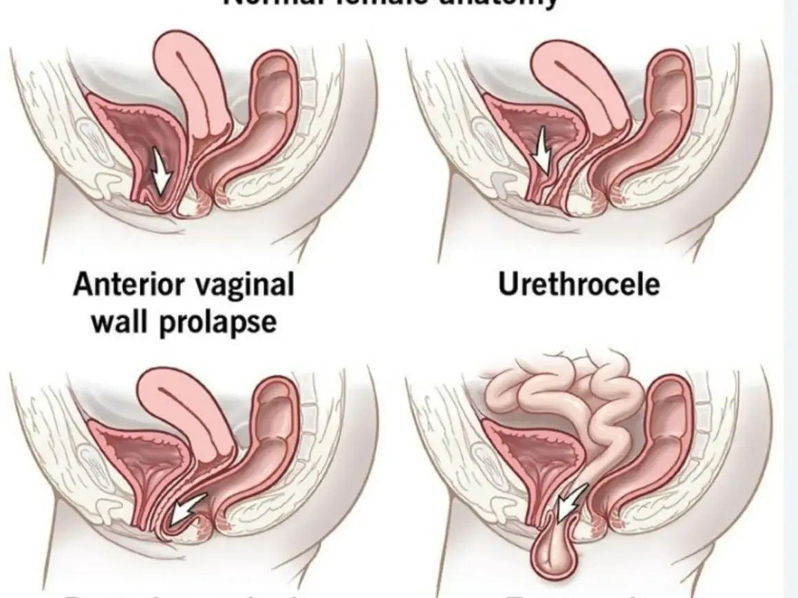 Illustrations de prolapsus vaginal. La question "peut-on avoir des rapports avec un prolapsus" est complexe et dépend de la sévérité.
