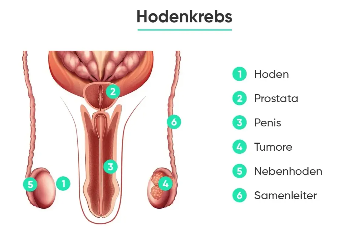 Anatomische Darstellung des männlichen Genitalbereichs mit Beschriftungen. Ein Tumor (4) ist im Hoden (1) zu sehen. Die Hodenkrebs prognose hängt vom Stadium ab.