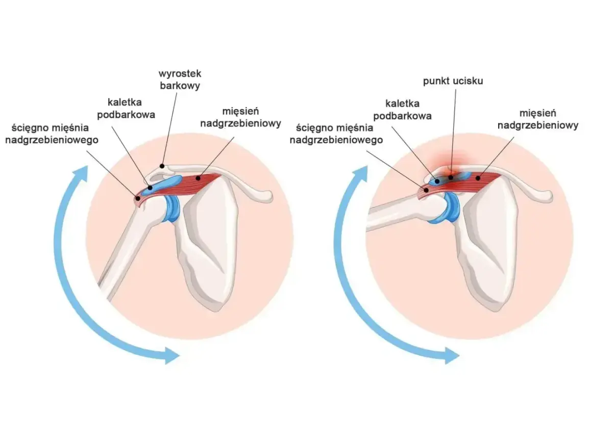 Anatomia barku: prawidłowe ułożenie ścięgna mięśnia nadgrzebieniowego i kaletki podbarkowej, a następnie ucisk na obojczyk podczas ruchu.