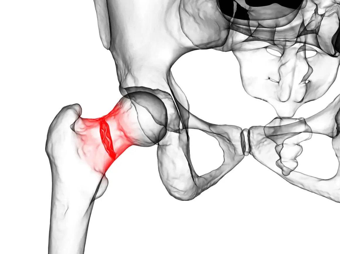 3D-Darstellung des menschlichen Beckens mit rot hervorgehobenem Oberschenkelhalsbruch, eine häufige Verletzung im Alter.