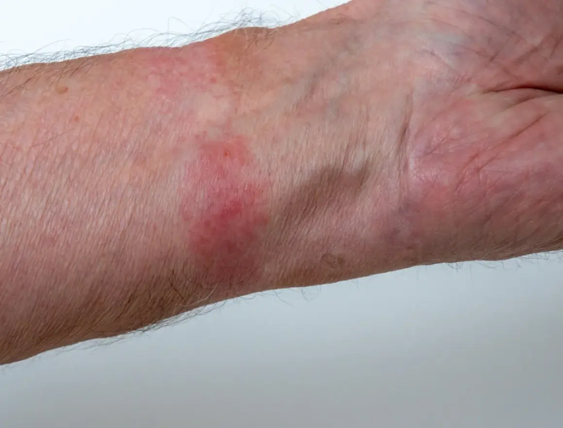 Pelle arrossata e irritata sul polso, sintomo di dermatite da contatto. Quanto dura? Dipende dalla causa.
