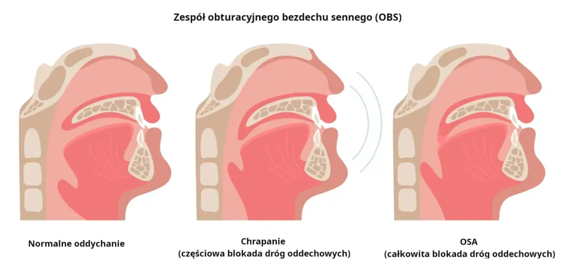 Ilustracja pokazuje przekrój dróg oddechowych przy normalnym oddychaniu, chrapaniu (częściowa blokada) i bezdechu sennym (całkowita blokada).