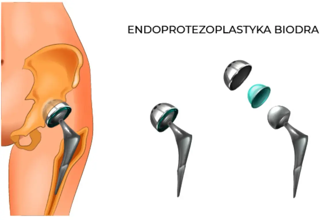 Schemat endoprotezy stawu biodrowego: implant w kości miednicy i kości udowej, oraz rozłożone elementy endoprotezy.