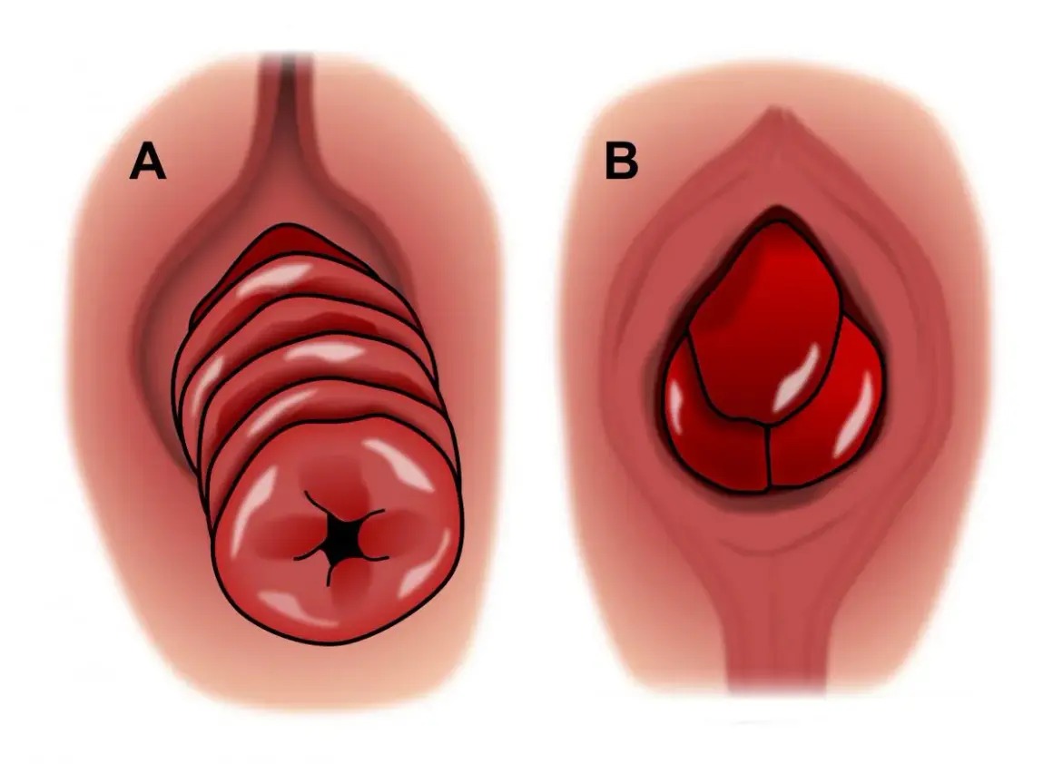 Illustration A montre une descente d'organes chez l'homme avec des plis distincts. Illustration B montre une masse rouge, possiblement une hernie.