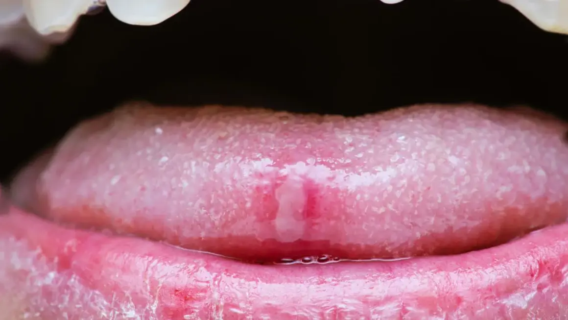 Nahaufnahme einer Zunge mit einer schmerzhaften Wunde, die auf einen Herpes zunge hindeutet. Die Lippen sind gerötet und gereizt.