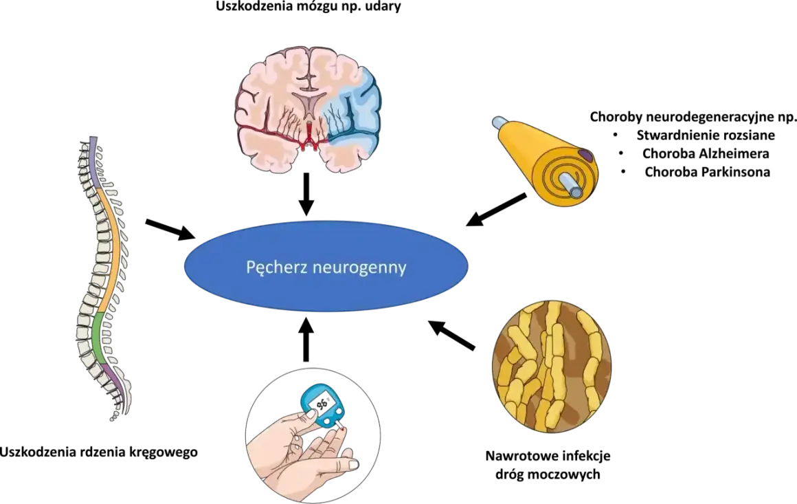 Pęcherz neurogenny może objawiać się problemami z oddawaniem moczu. Ilustracja pokazuje mózg, rdzeń kręgowy, nerw, cukrzycę i komórki nerwowe.