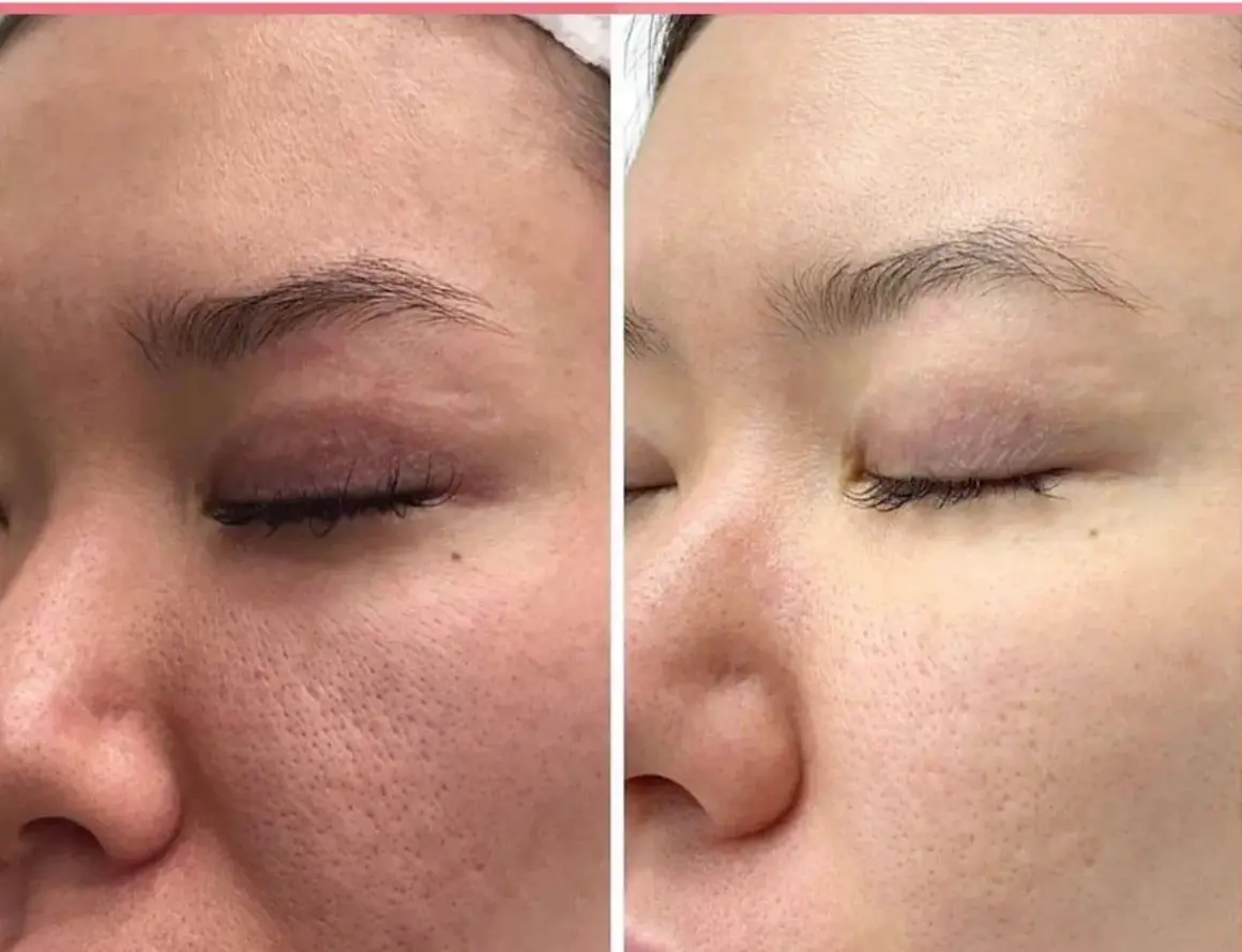 Vergleich: Haut mit großen Poren vor und nach der Anwendung von Retinol. Die Haut wirkt feiner und ebenmäßiger.
