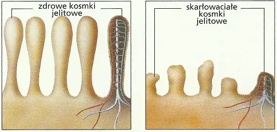 Nietolerancja glutenu: objawy, różnice, diagnoza i dieta