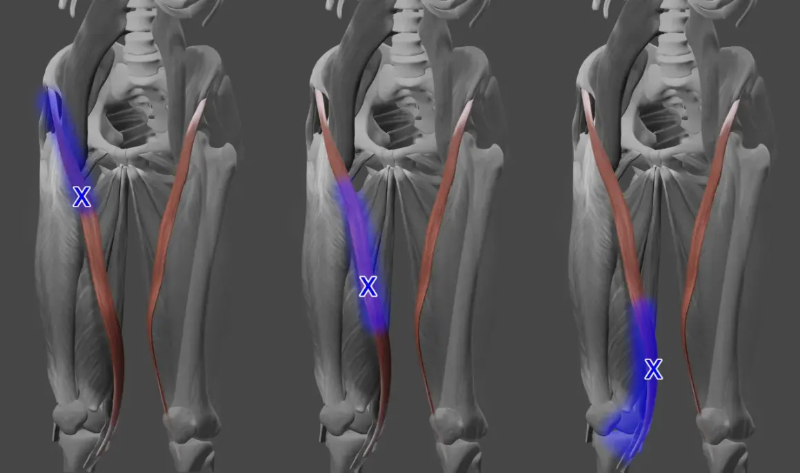 Musculus sartorius: Der Schneider-Muskel, hervorgehoben in Blau, verläuft diagonal über den Oberschenkel.