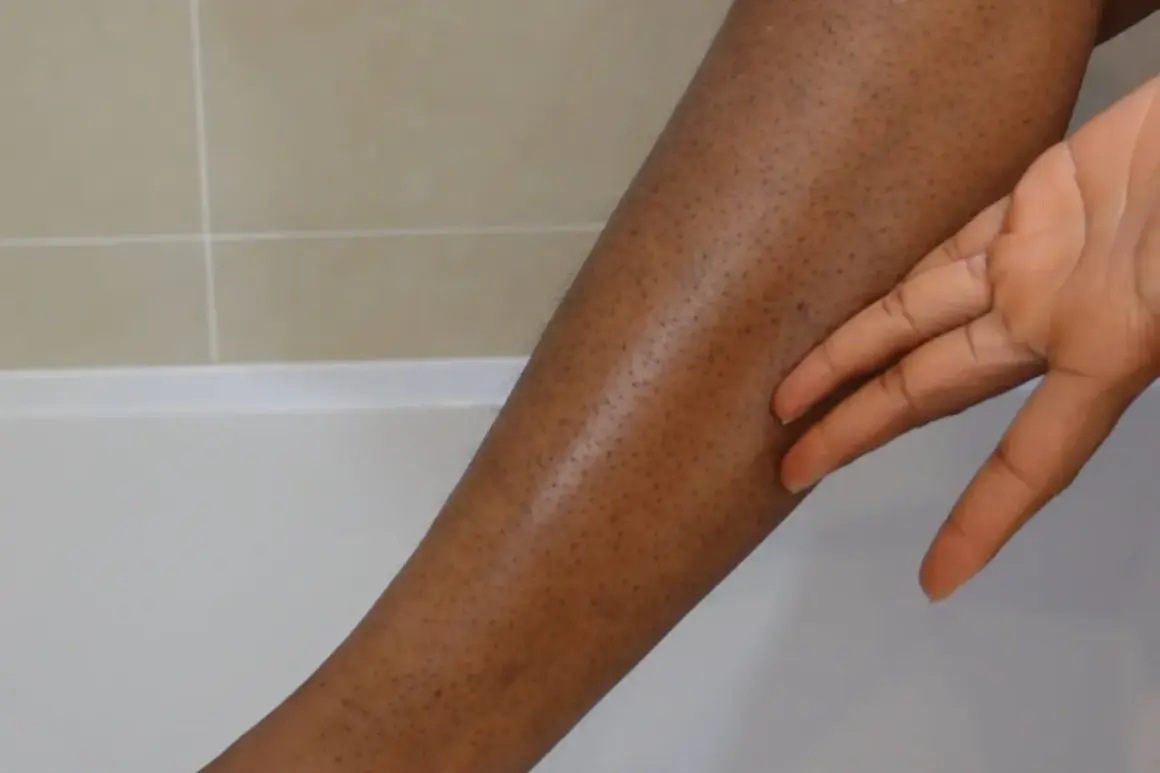 En hand rör vid en ben med mörka prickar, som ger ett utseende av "strawberry legs".