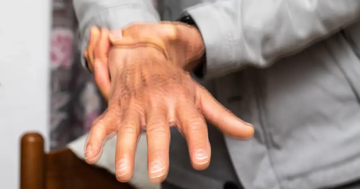 Dłoń z drżeniem, objawem sugerującym parkinsonizm.