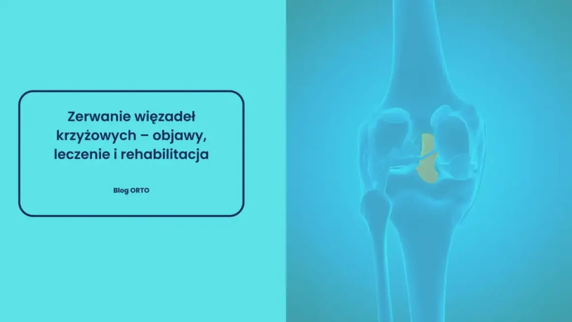 Ilustracja przedstawia zerwane więzadło krzyżowe w kolanie. Czy zerwane więzadło boli? Dowiedz się o objawach, leczeniu i rehabilitacji.