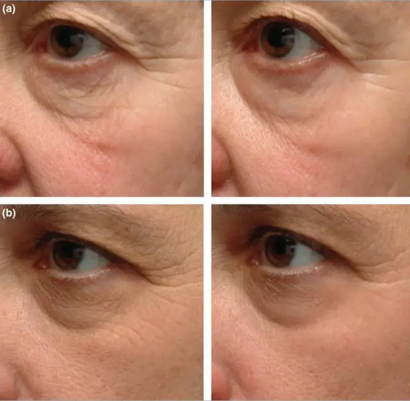 Retinol lek na co? Odkryj jego skutki i zastosowania w terapii skóry