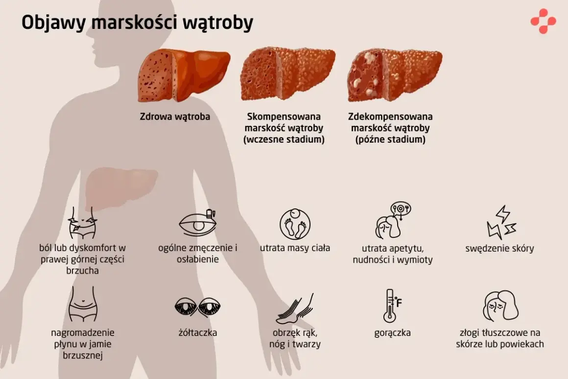 Objawy marskości wątroby: ból brzucha, zmęczenie, utrata masy ciała, żółtaczka, obrzęki, gorączka. Tak wygląda jak umiera się na marskość wątroby.