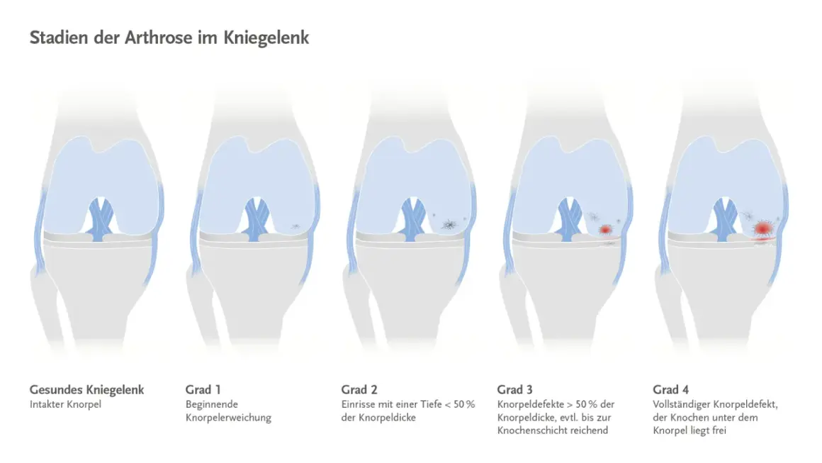 Illustrationen zeigen die Stadien der Arthrose im Kniegelenk, von gesundem Knorpel bis zum vollständigen Knorpeldefekt.