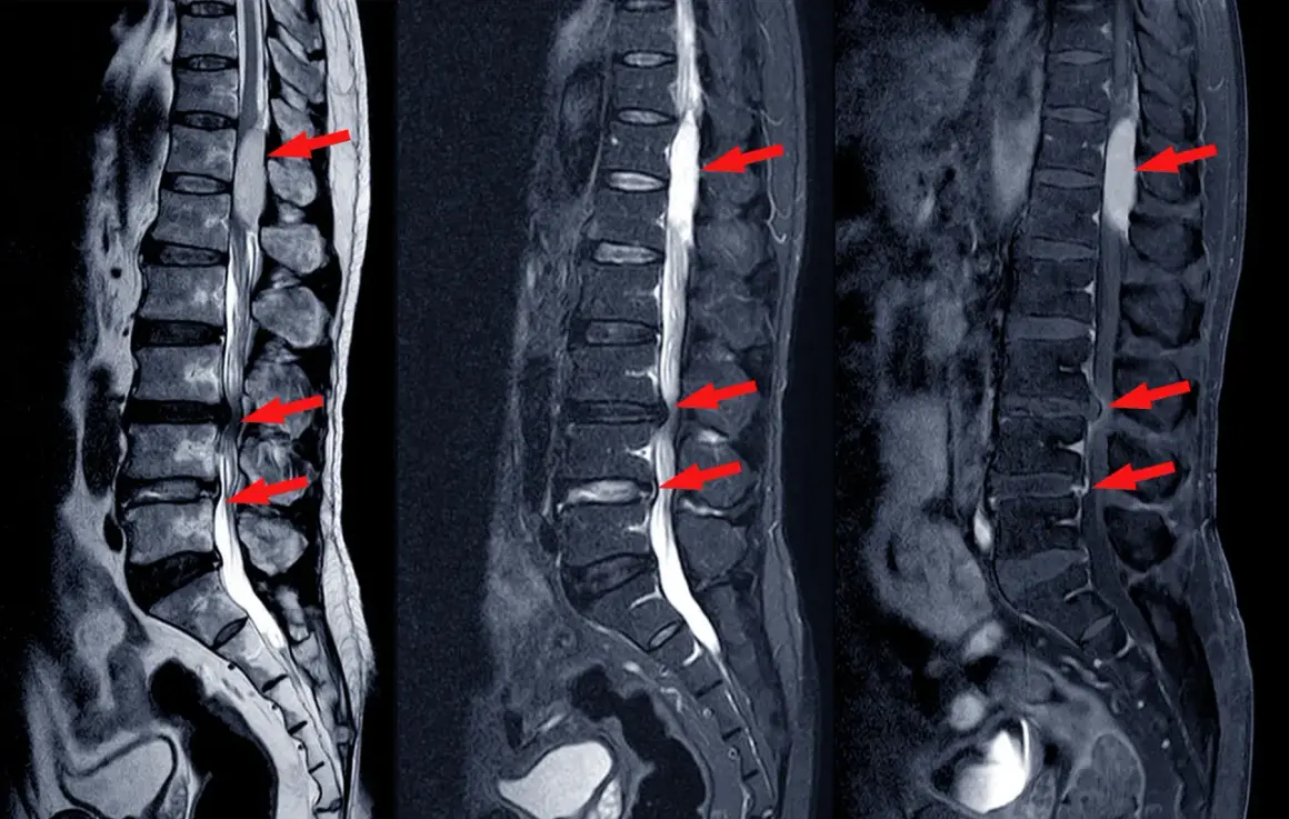 MRI kręgosłupa lędźwiowego pokazuje przepuklinę dysku, która może powodować silny ból. Czerwone strzałki wskazują na ucisk na rdzeń kręgowy.