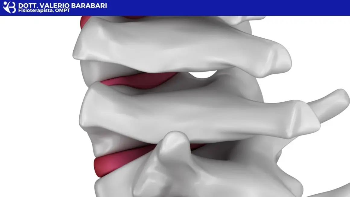 Dettaglio anatomico della colonna vertebrale, con dischi intervertebrali rossi tra le vertebre bianche. Illustra la potenziale area di interesse per la lordosi cura.