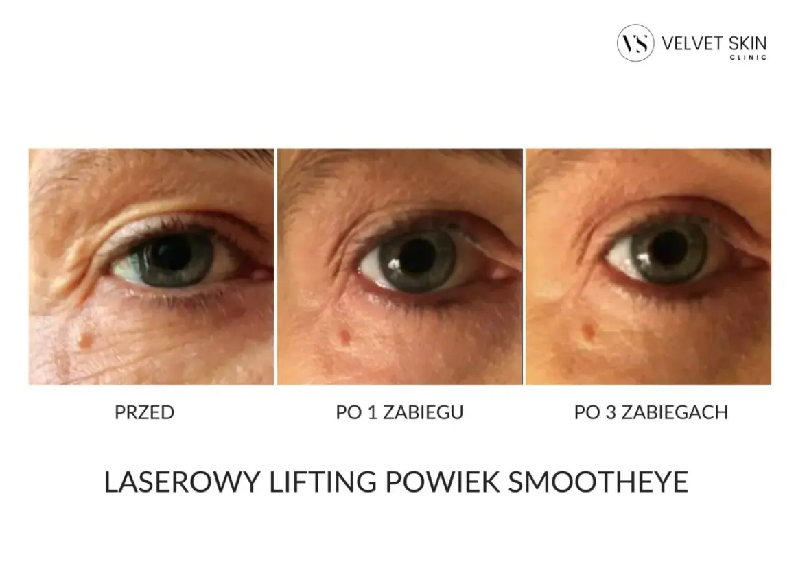 Przed i po zabiegach laserowego liftingu powiek. Efekty widoczne po 1 i 3 zabiegach. Laserowy lifting powiek ile się utrzymuje? Sprawdź efekty!