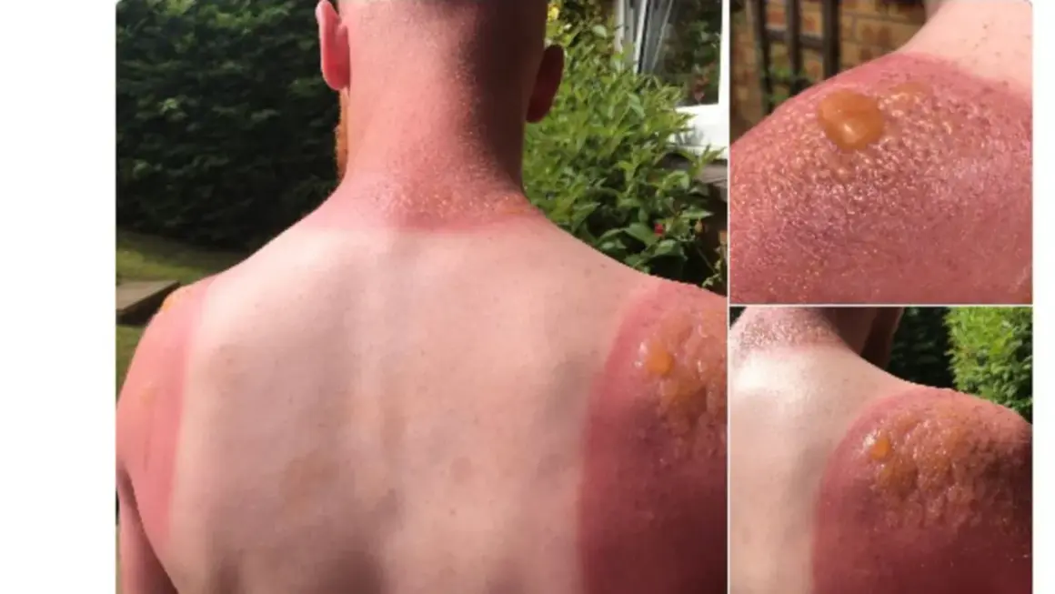 Schwerer Sonnenbrand mit Blasenbildung an Schultern und Nacken. Die Frage "wie lange dauert ein sonnenbrand" wird hier schmerzhaft beantwortet.