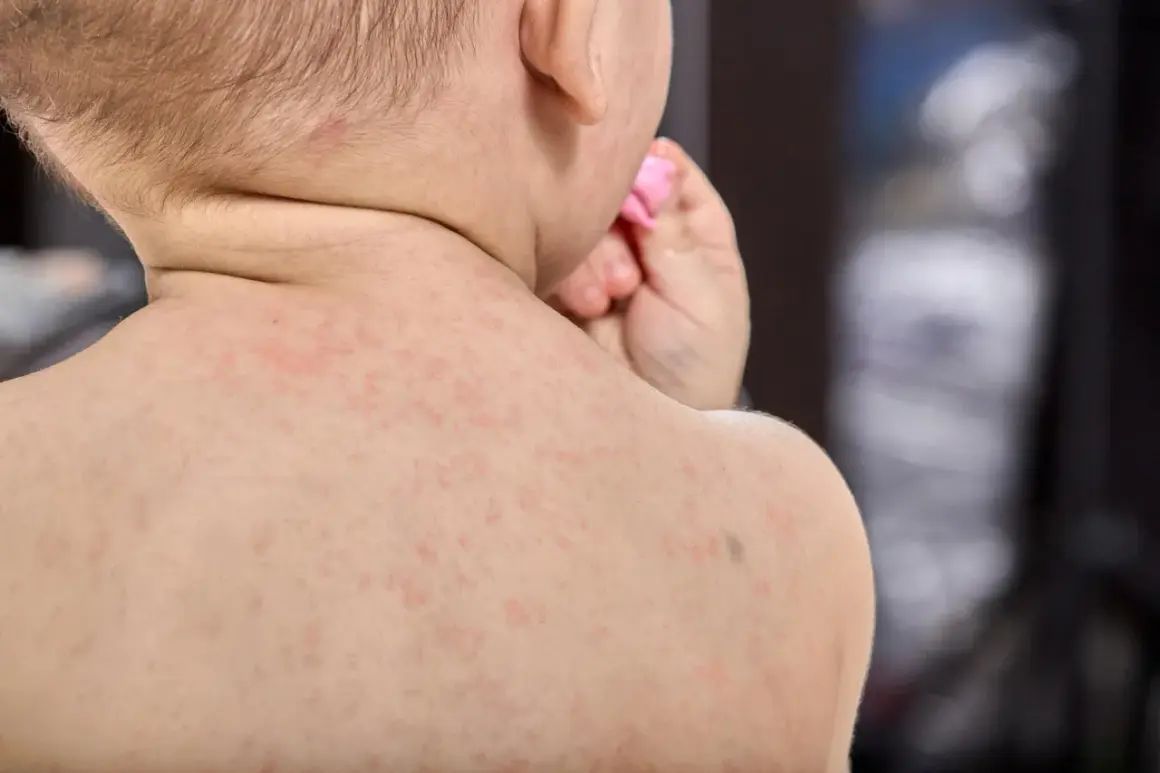 Bebé con sarpullido en la espalda, posible síntoma de meningitis.