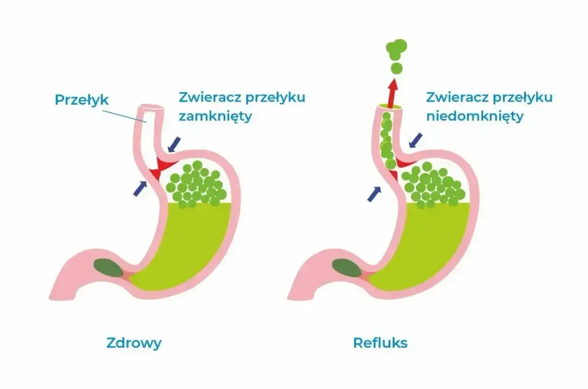 Ilustracja pokazuje refluks żołądkowo-przełykowy. Zobacz domowe sposoby na uczucie gula w gardle.
