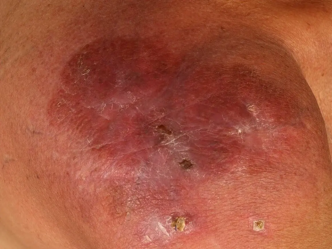Hautläsionen, die auf multiples Myelom hindeuten. Rötliche, geschwollene Stelle mit schuppiger Oberfläche und kleinen Krusten.